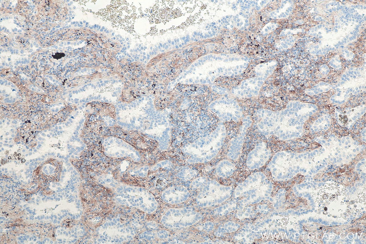 Immunohistochemical analysis of paraffin-embedded human lung cancer tissue slide using KHC0081 (CD90 IHC Kit).