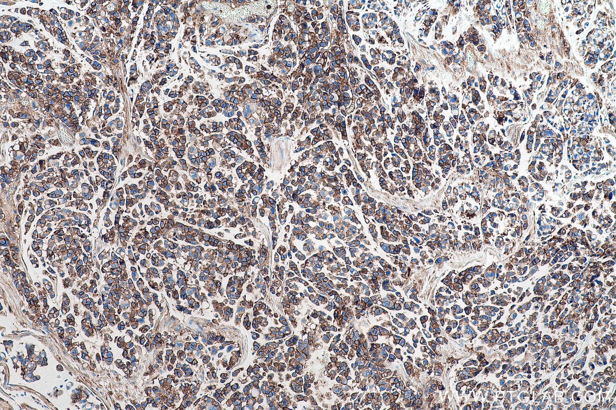 Immunohistochemical analysis of paraffin-embedded human colon cancer tissue slide using KHC0953 (CD98/SLC3A2 IHC Kit).
