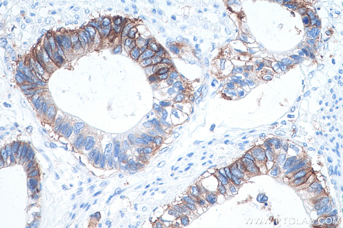 Immunohistochemical analysis of paraffin-embedded human urothelial carcinoma tissue slide using KHC0953 (CD98/SLC3A2 IHC Kit).