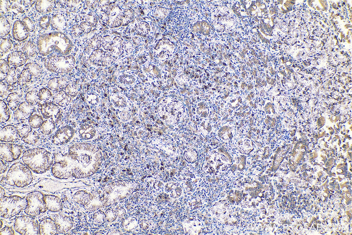 Immunohistochemical analysis of paraffin-embedded human stomach cancer tissue slide using KHC0609 (Cdc20 IHC Kit).