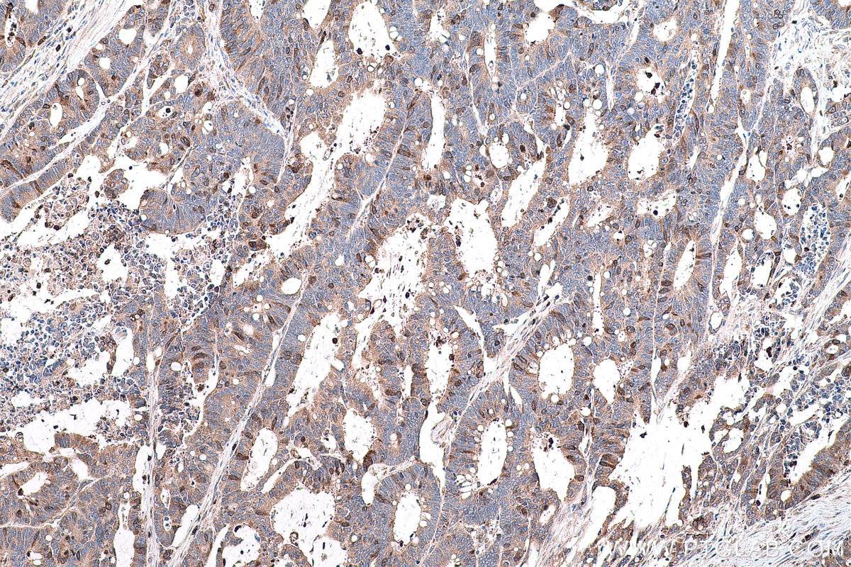 Immunohistochemical analysis of paraffin-embedded human colon cancer tissue slide using KHC0609 (Cdc20 IHC Kit).