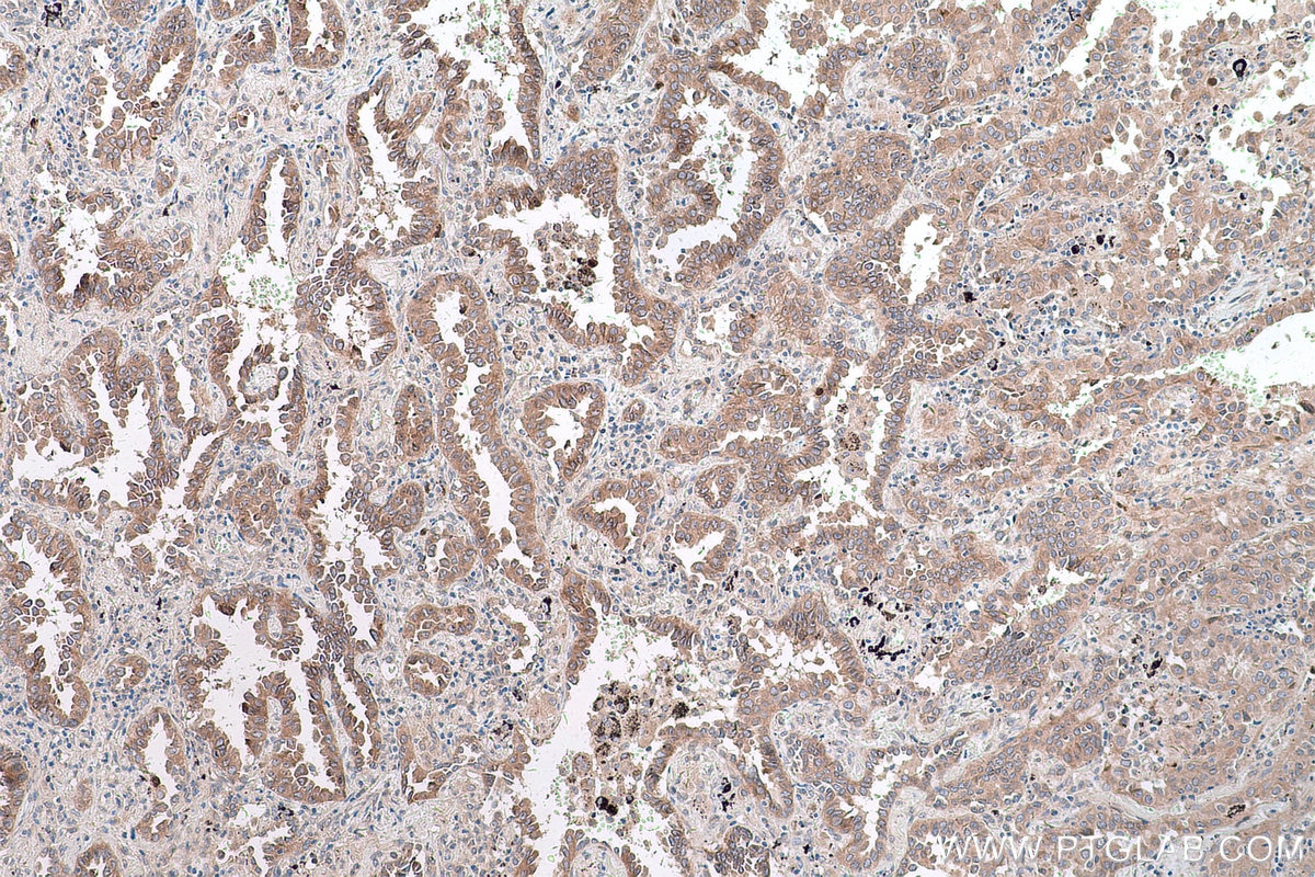 Immunohistochemical analysis of paraffin-embedded human lung cancer tissue slide using KHC0609 (Cdc20 IHC Kit).