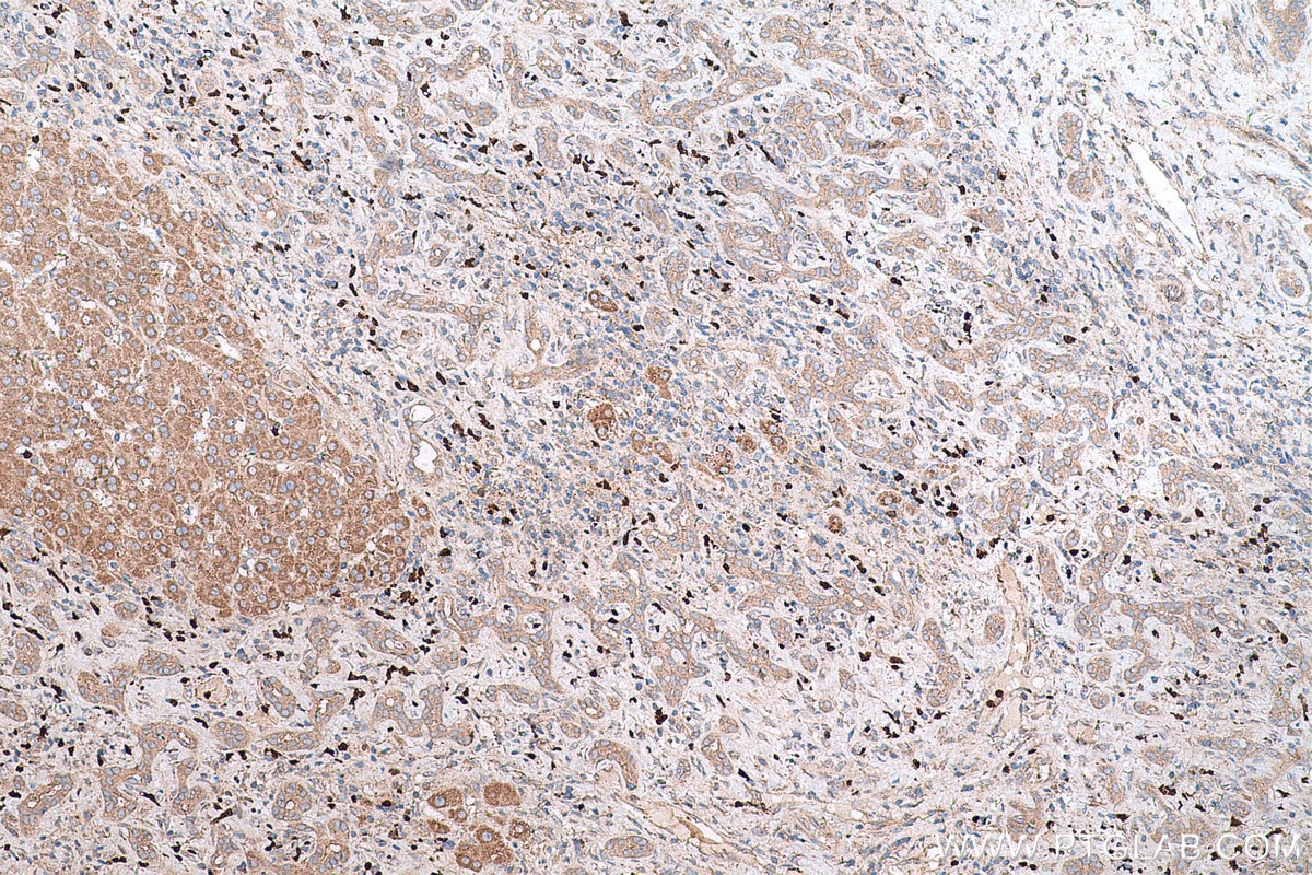 Immunohistochemical analysis of paraffin-embedded human liver cancer tissue slide using KHC0609 (Cdc20 IHC Kit).
