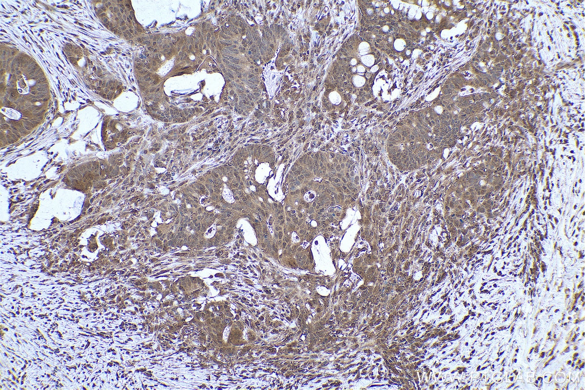 Immunohistochemical analysis of paraffin-embedded human colon cancer tissue slide using KHC0805 (CDC25B IHC Kit).