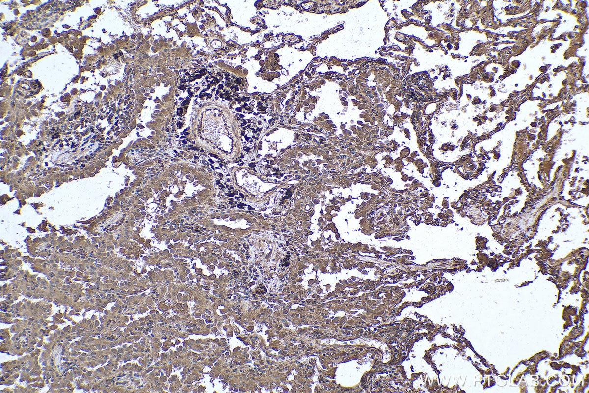Immunohistochemical analysis of paraffin-embedded human lung cancer tissue slide using KHC0805 (CDC25B IHC Kit).