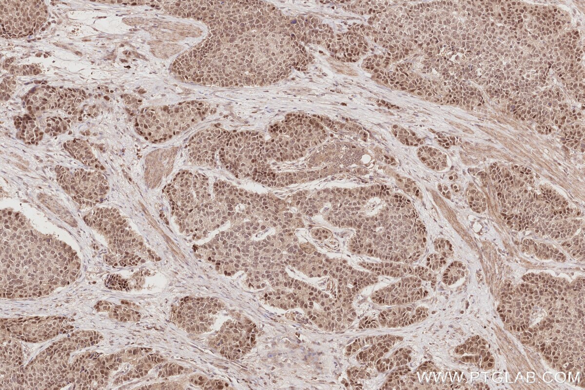 Immunohistochemical analysis of paraffin-embedded human stomach cancer tissue slide using KHC2879 (CDC2L6 IHC Kit).