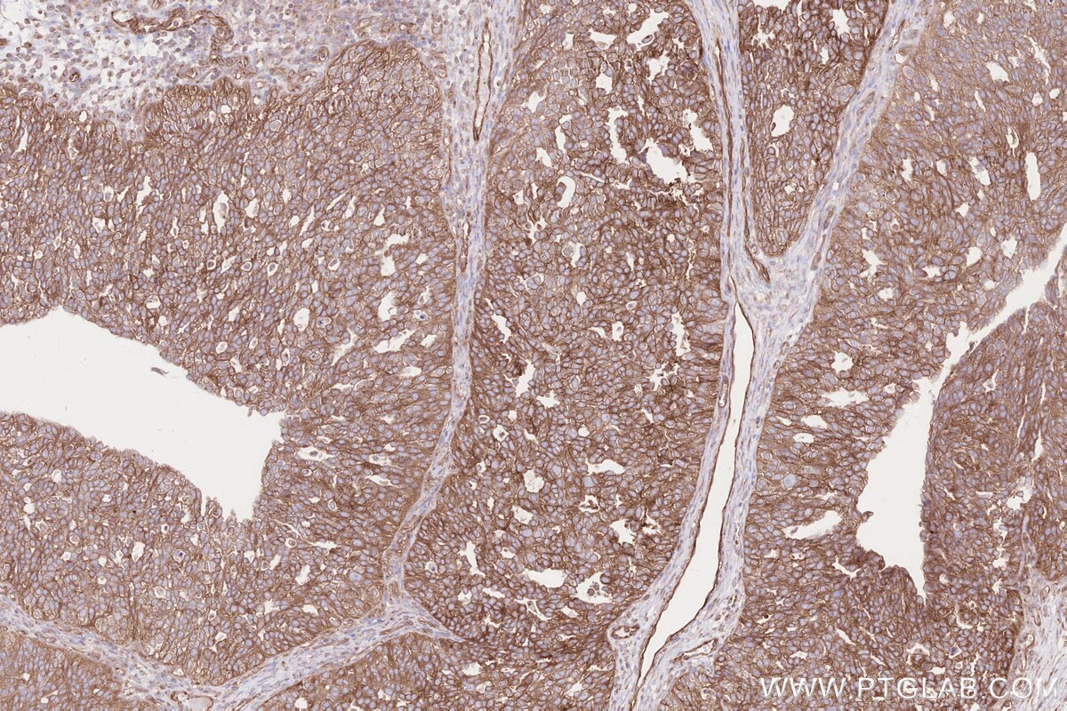 Immunohistochemical analysis of paraffin-embedded human ovary cancer tissue slide using KHC2562 (CDC42BPA IHC Kit).