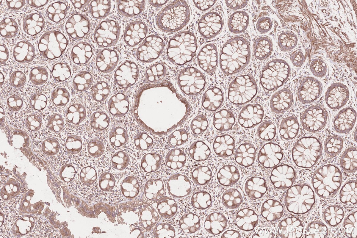 Immunohistochemical analysis of paraffin-embedded human rectal cancer tissue slide using KHC2562 (CDC42BPA IHC Kit).