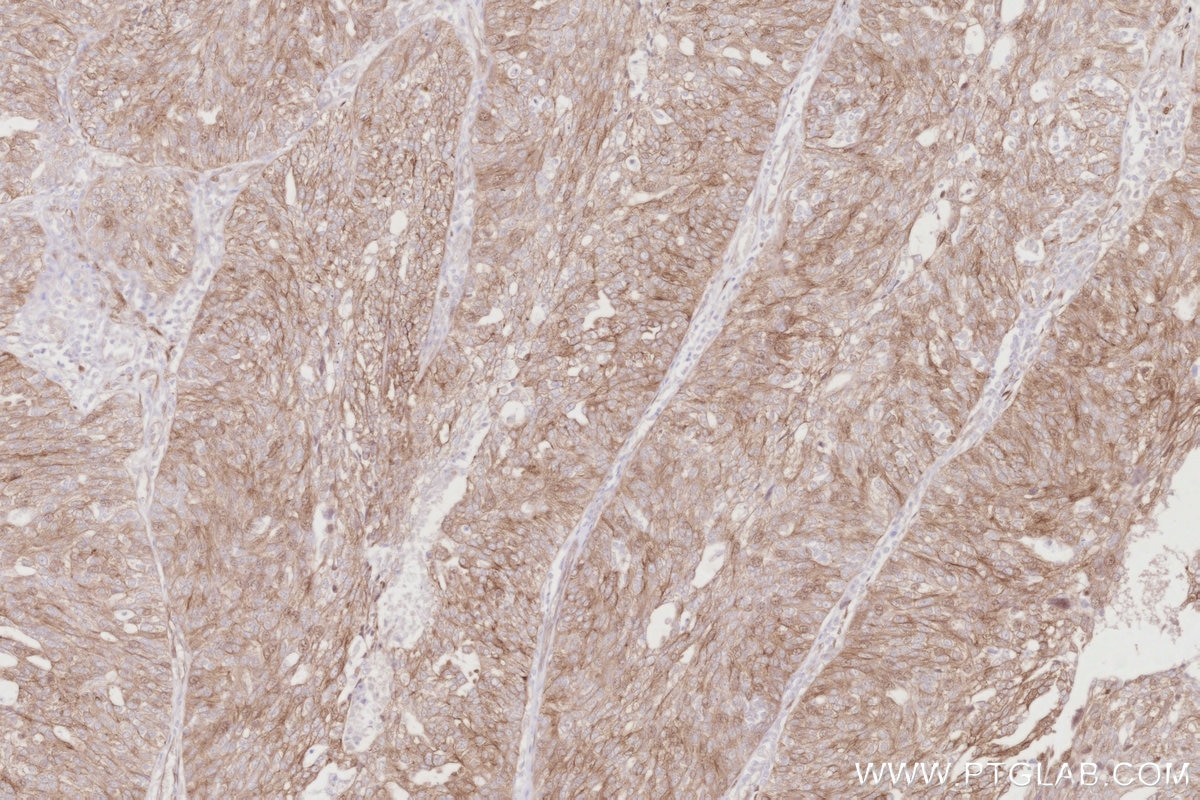 Immunohistochemical analysis of paraffin-embedded human ovary cancer tissue slide using KHC2911 (CDC42EP4 IHC Kit).