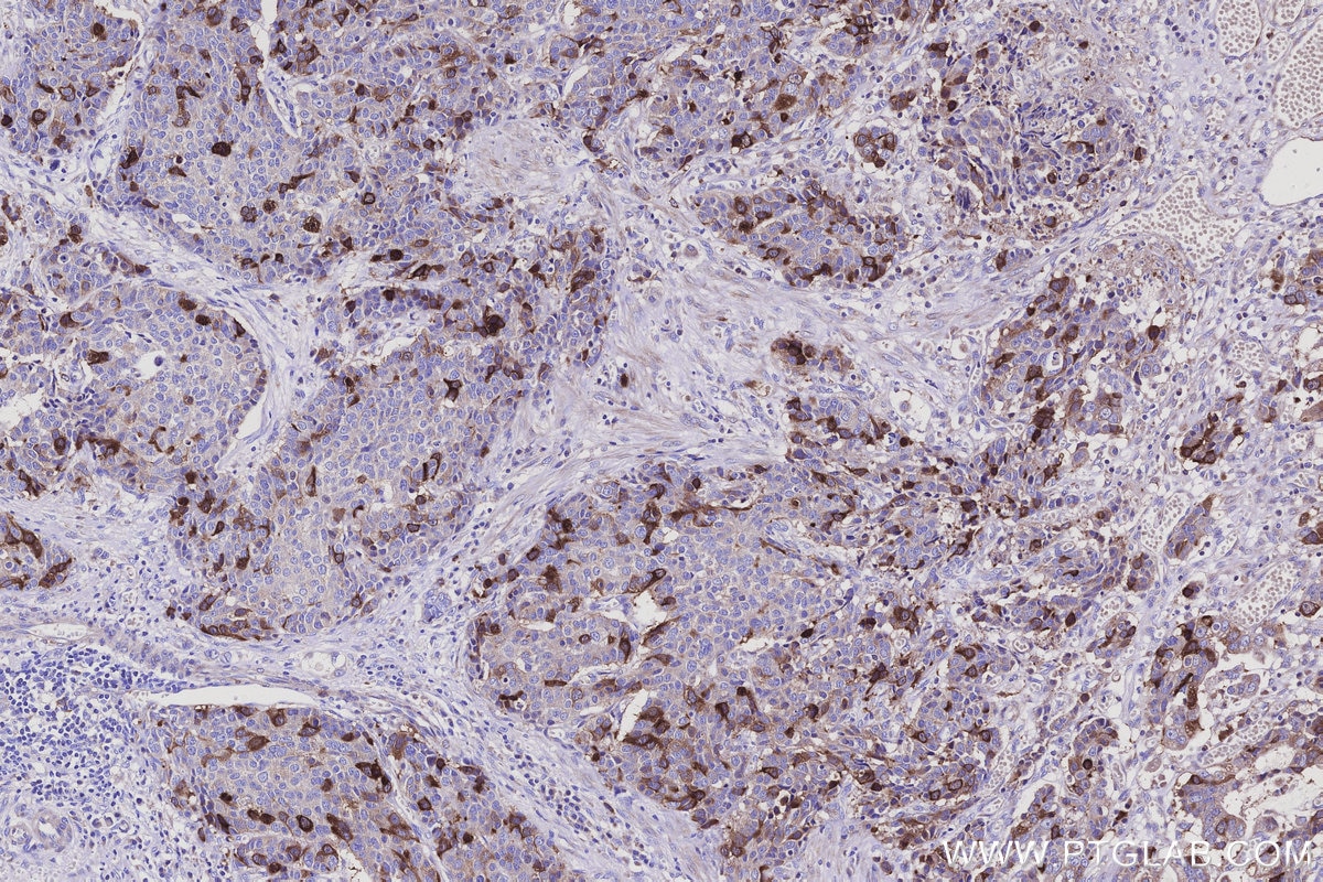 Immunohistochemical analysis of paraffin-embedded human stomach cancer tissue slide using KHC3112 (CDCA3 IHC Kit). Immunohistochemical analysis of paraffin-embedded human stomach cancer tissue slide using KHC3112 (CDCA3 IHC Kit).
