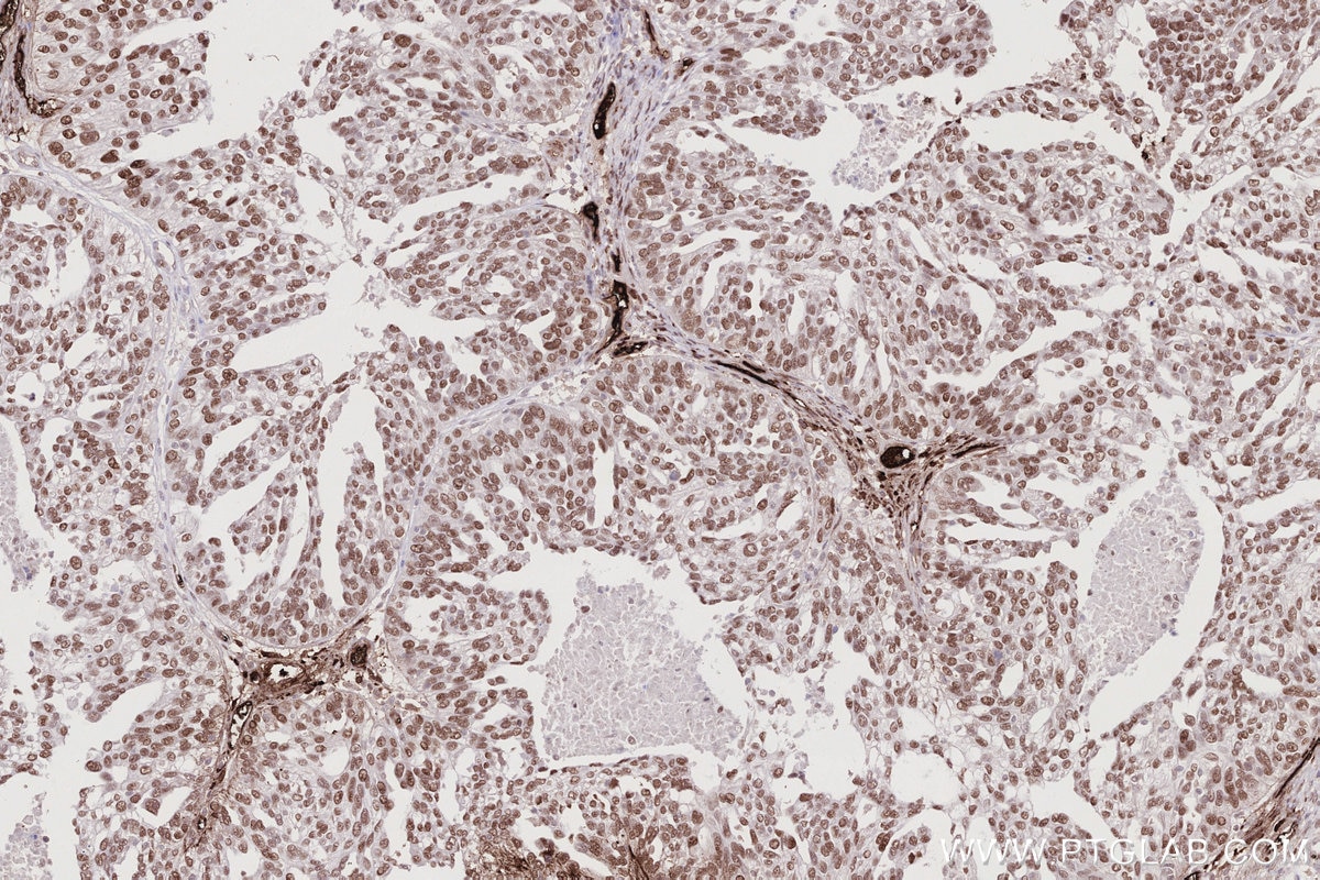 Immunohistochemical analysis of paraffin-embedded human ovary cancer tissue slide using KHC2791 (CDCA5 IHC Kit).