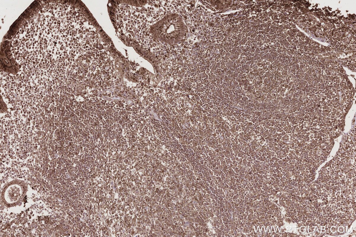 Immunohistochemical analysis of paraffin-embedded human appendicitis tissue slide using KHC2795 (CDCA7L IHC Kit).
