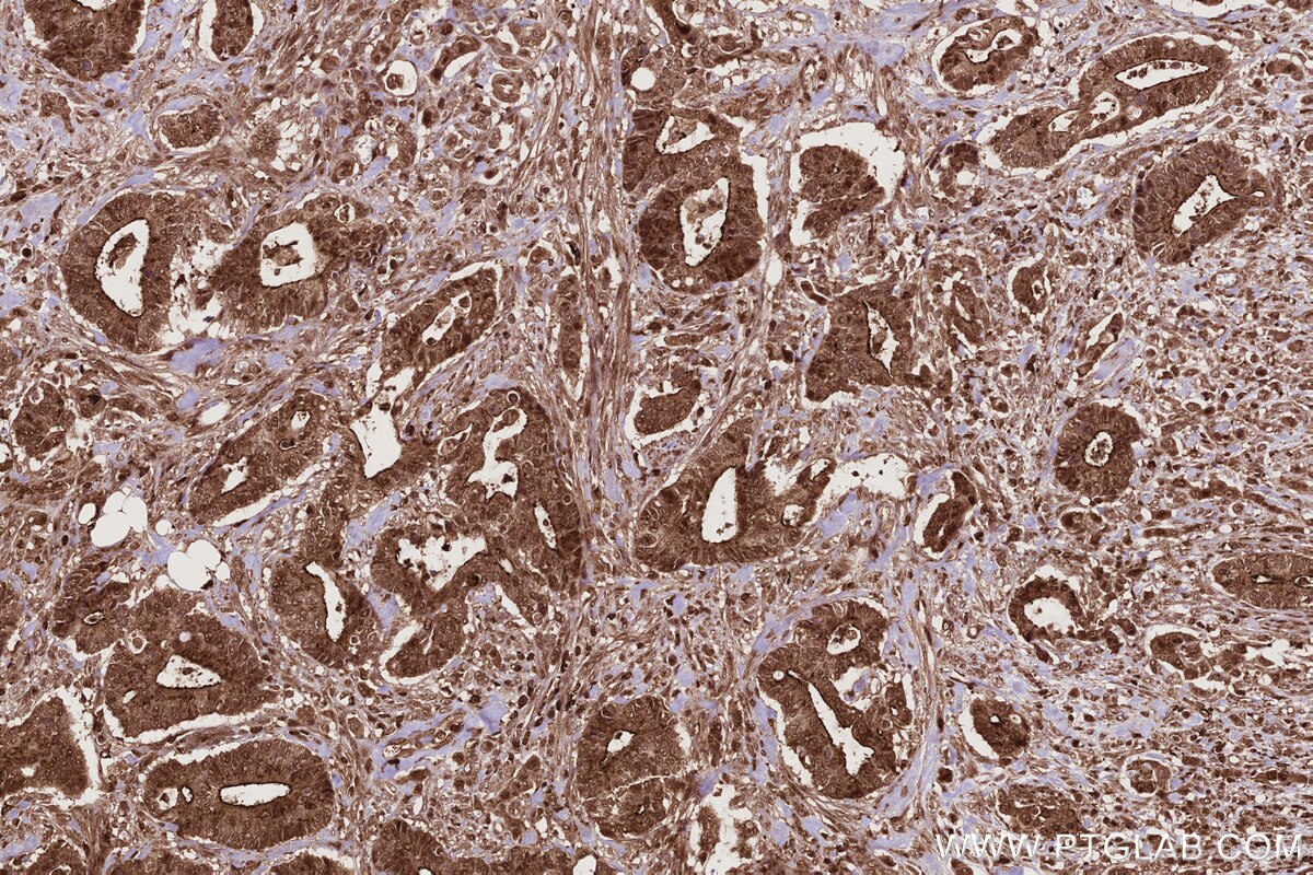 Immunohistochemical analysis of paraffin-embedded human rectal cancer tissue slide using KHC2795 (CDCA7L IHC Kit).