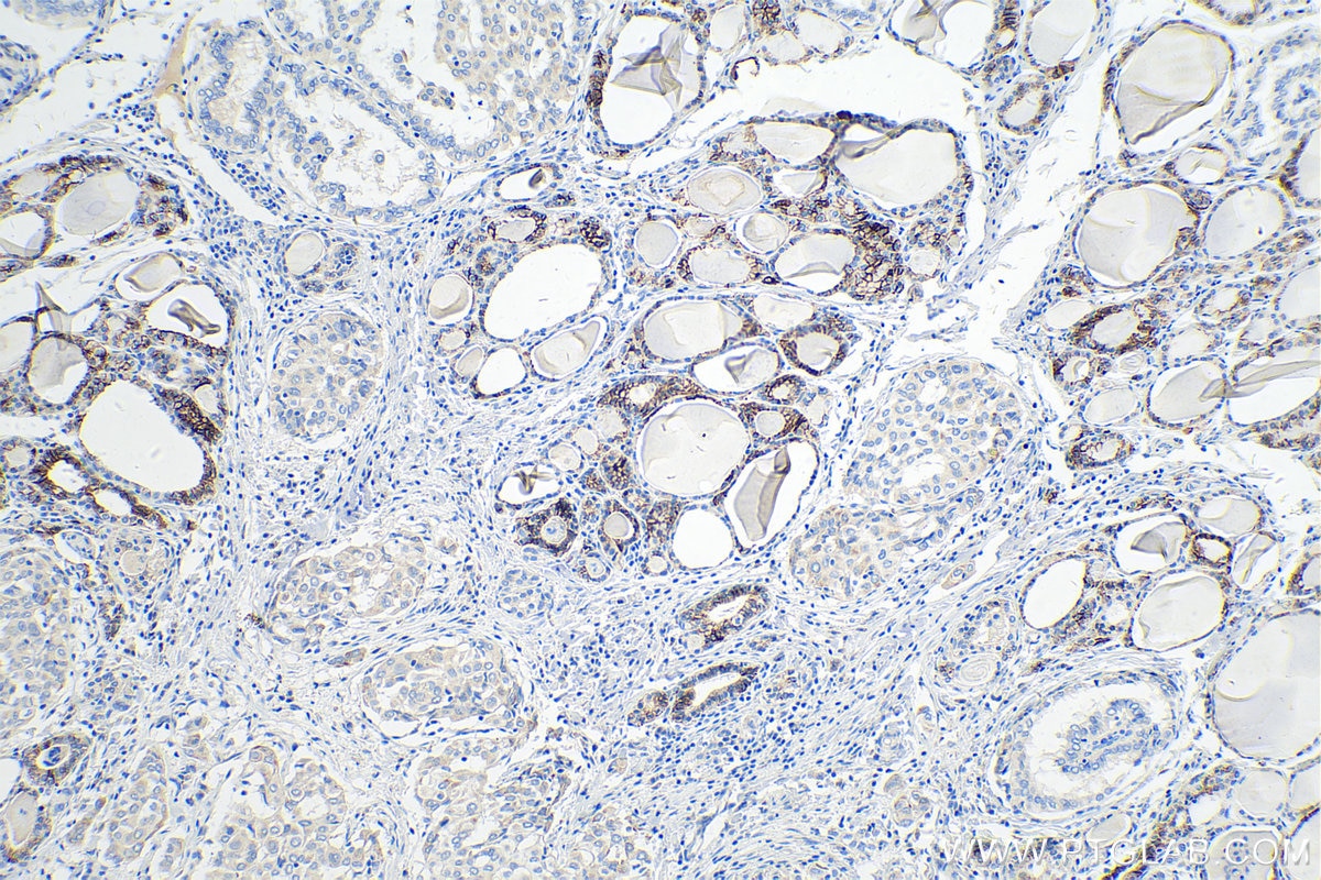 Immunohistochemical analysis of paraffin-embedded human thyroid cancer tissue slide using KHC0214 (Cadherin-16 IHC Kit).