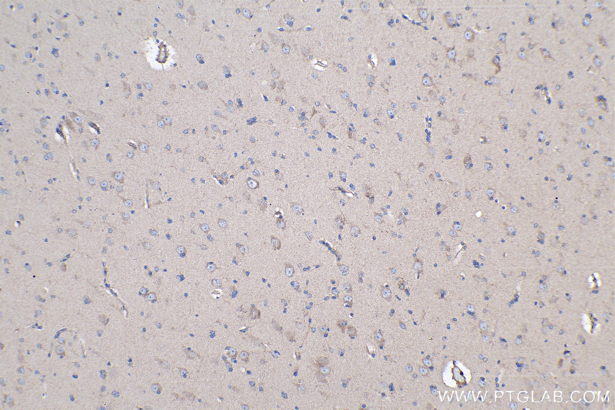 Immunohistochemical analysis of paraffin-embedded human gliomas tissue slide using KHC0254 (CDH7 IHC Kit).