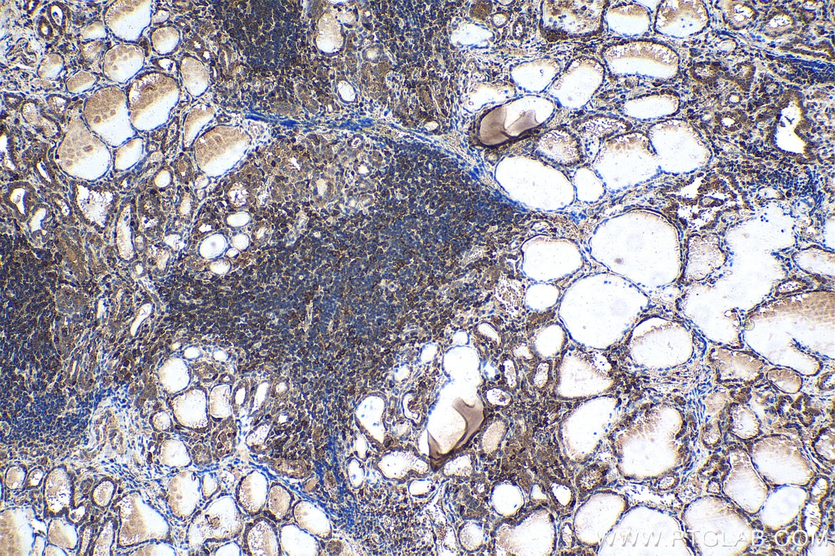 Immunohistochemical analysis of paraffin-embedded human thyroid cancer tissue slide using KHC1511 (CDK1 IHC Kit).