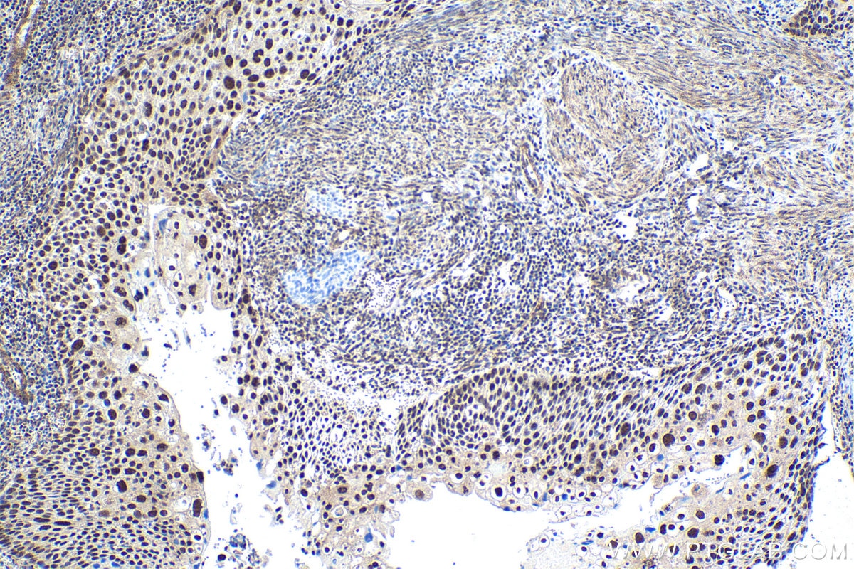 Immunohistochemical analysis of paraffin-embedded human cervical cancer tissue slide using KHC1723 (CDK13 IHC Kit).