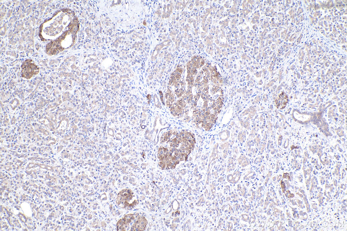 Immunohistochemical analysis of paraffin-embedded human pancreas cancer tissue slide using KHC2380 (CDK16/PCTAIRE1 IHC Kit).