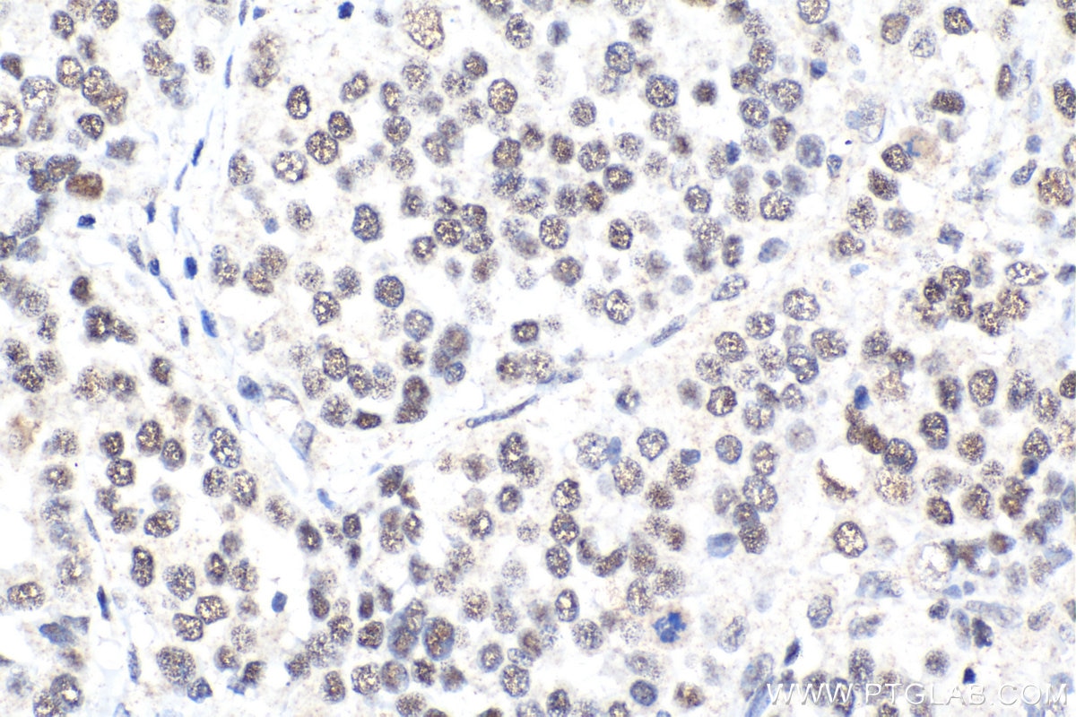 Immunohistochemical analysis of paraffin-embedded human ovary tumor tissue slide using KHC2124 (CDK2AP2 IHC Kit).