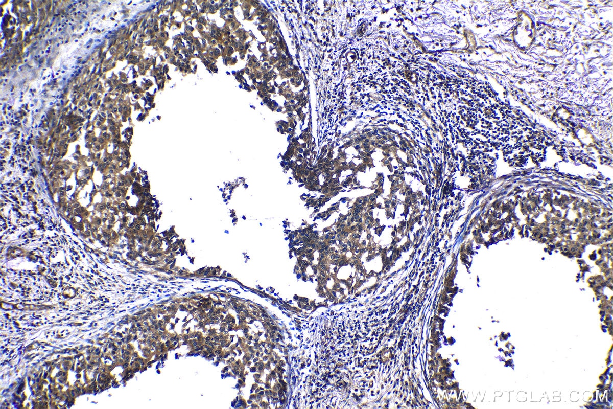 Immunohistochemical analysis of paraffin-embedded human breast cancer tissue slide using KHC1187 (CDK3 IHC Kit).