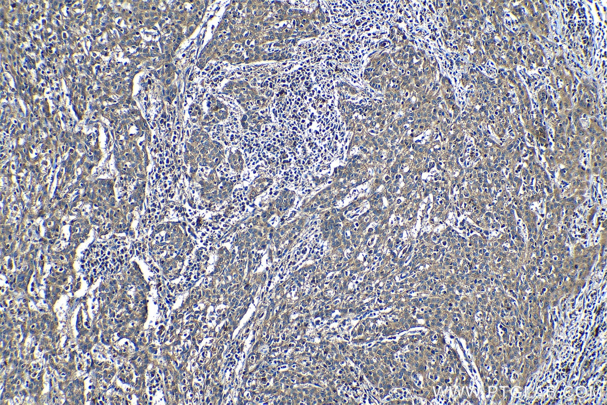 Immunohistochemical analysis of paraffin-embedded human cervical cancer tissue slide using KHC1187 (CDK3 IHC Kit).