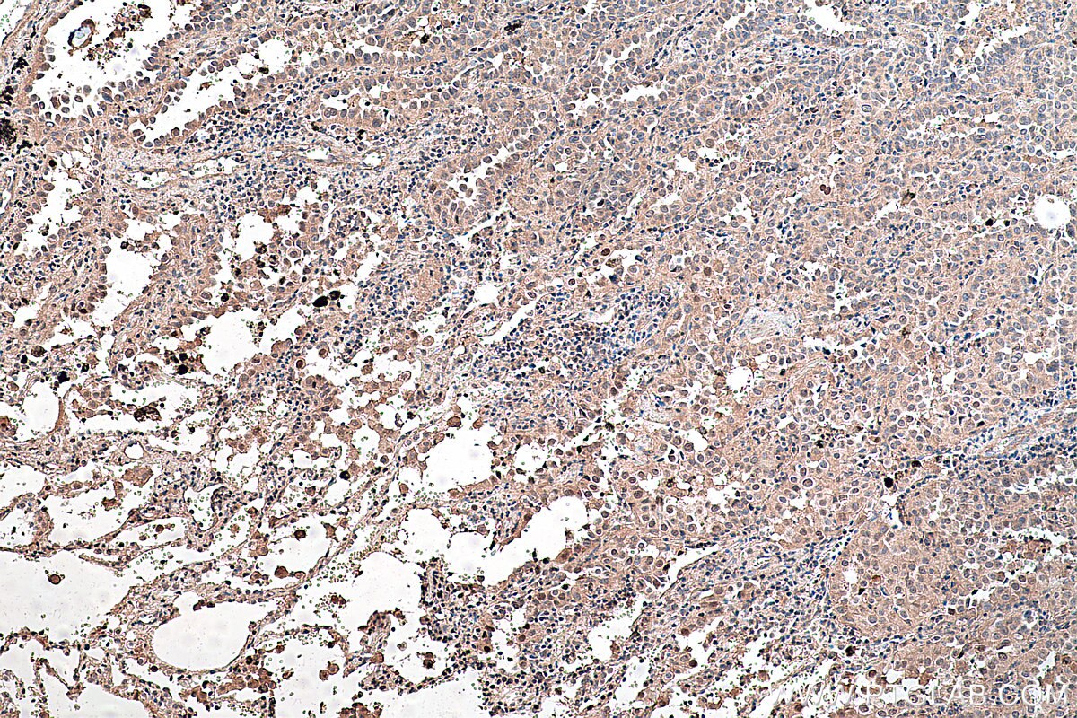 Immunohistochemical analysis of paraffin-embedded human lung cancer tissue slide using KHC0303 (CDK4 IHC Kit).