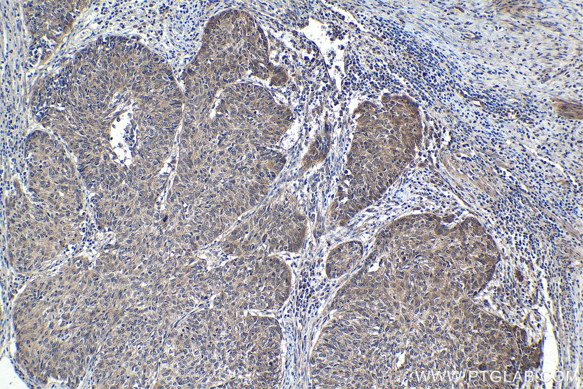Immunohistochemical analysis of paraffin-embedded human cervical cancer tissue slide using KHC1657 (CDK5 IHC Kit).