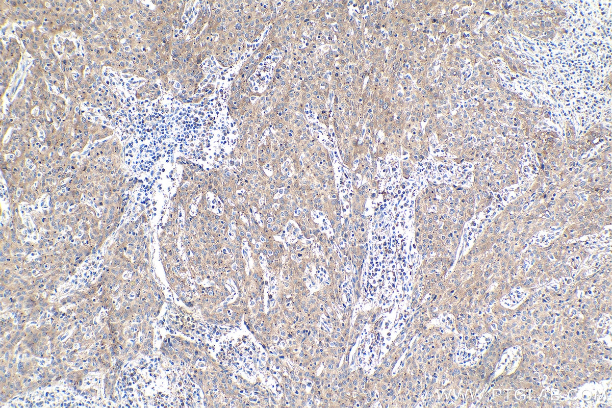 Immunohistochemical analysis of paraffin-embedded human cervical cancer tissue slide using KHC1748 (CDK5R1 IHC Kit).