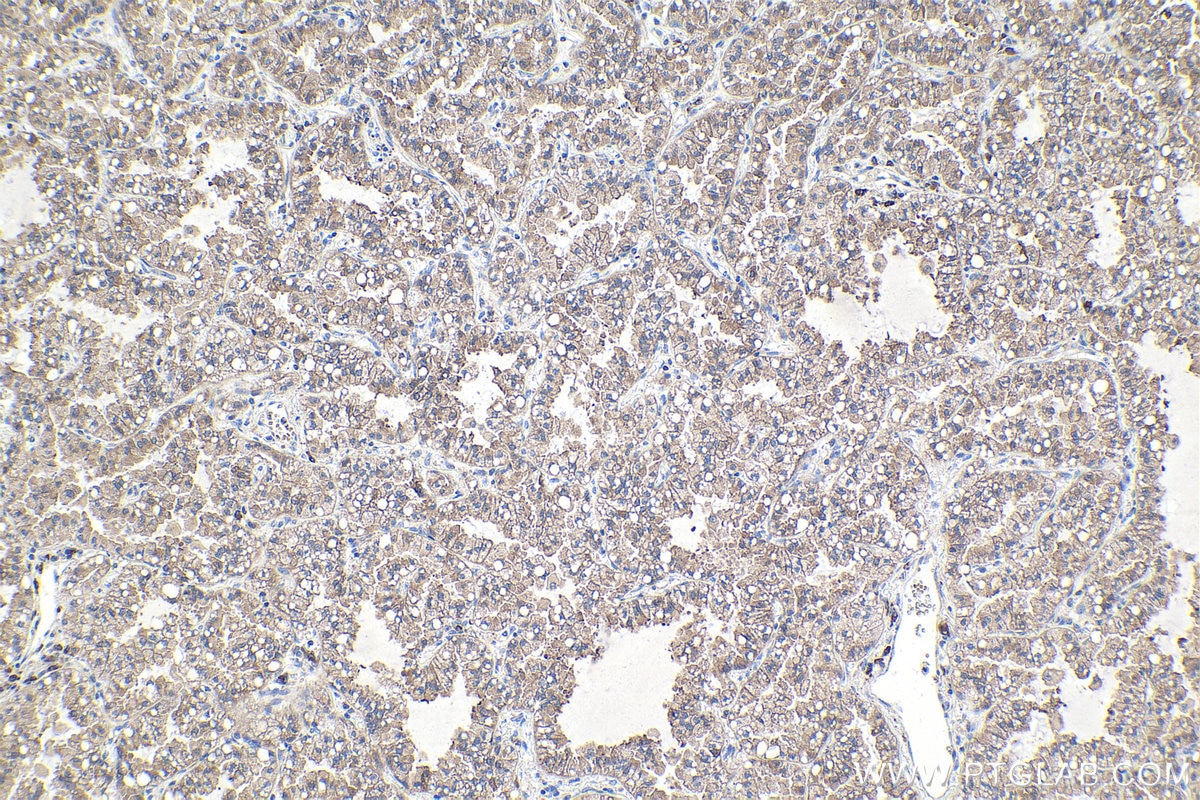 Immunohistochemical analysis of paraffin-embedded human lung cancer tissue slide using KHC1748 (CDK5R1 IHC Kit).