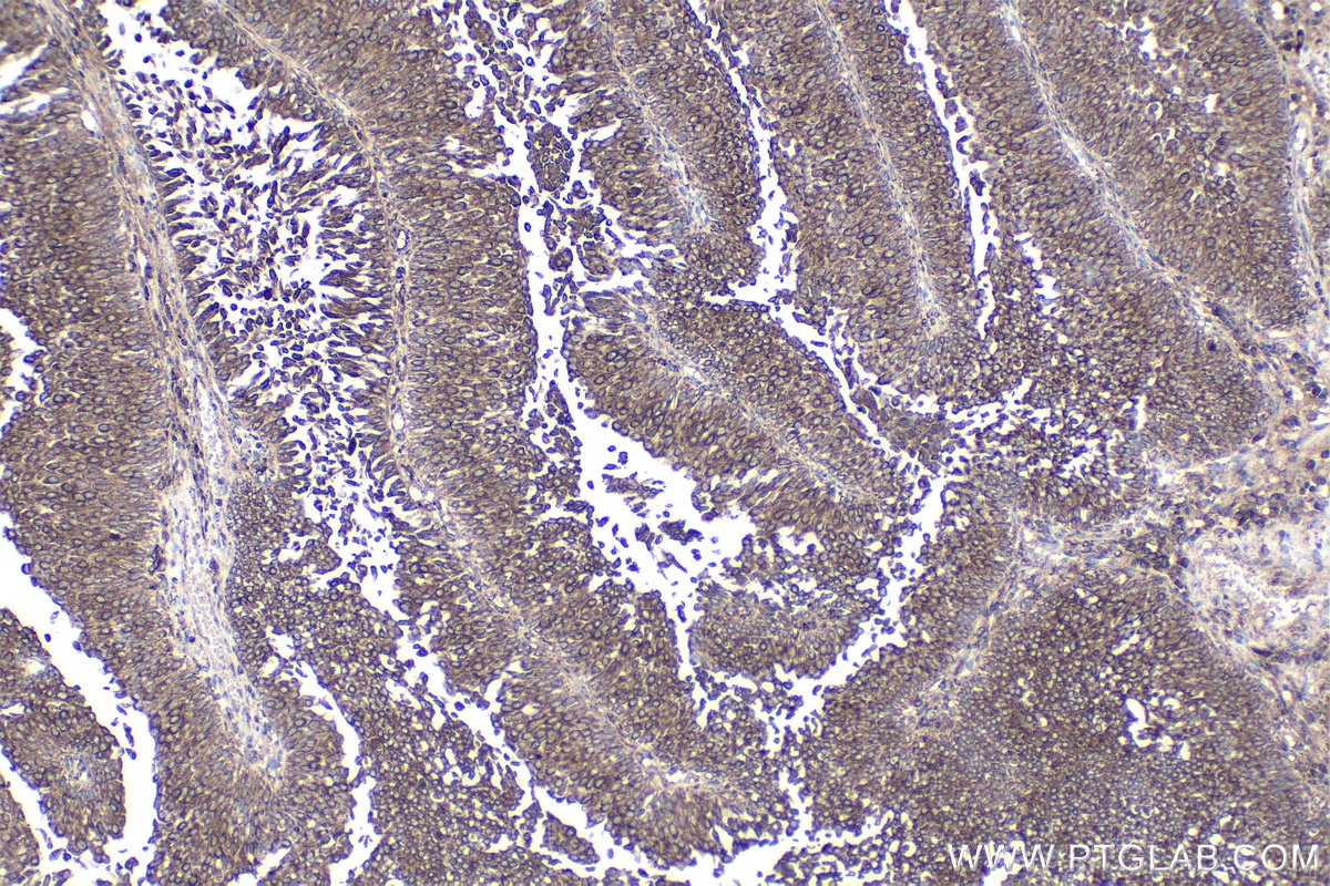 Immunohistochemical analysis of paraffin-embedded human urothelial carcinoma tissue slide using KHC1876 (CDK5RAP3 IHC Kit).