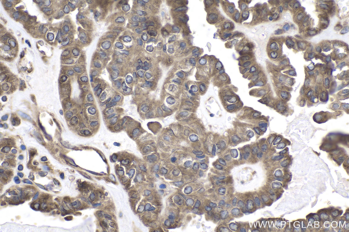 Immunohistochemical analysis of paraffin-embedded human thyroid cancer tissue slide using KHC1876 (CDK5RAP3 IHC Kit).