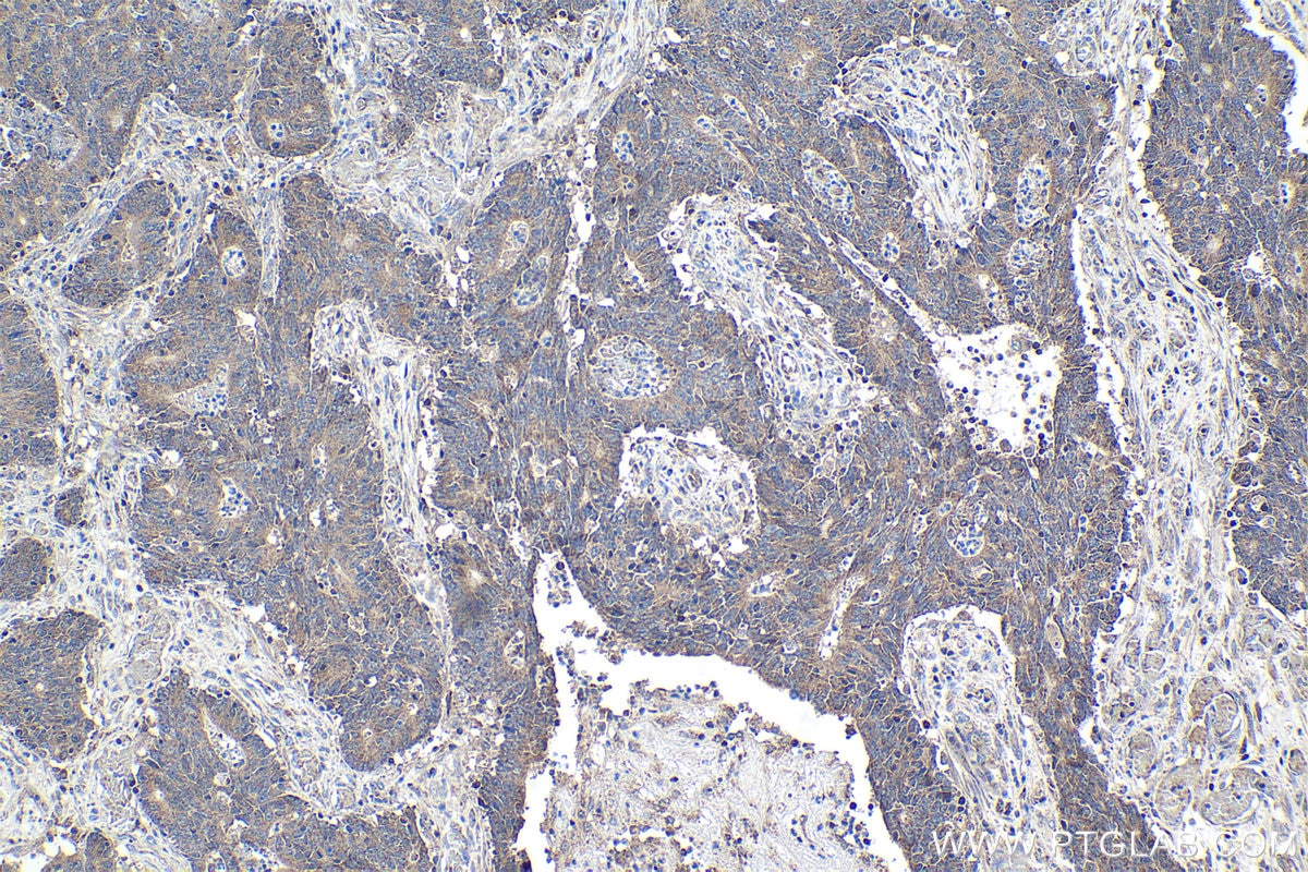Immunohistochemical analysis of paraffin-embedded human colon cancer tissue slide using KHC1068 (CDK6 IHC Kit).