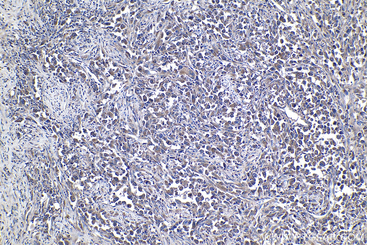 Immunohistochemical analysis of paraffin-embedded human lung cancer tissue slide using KHC1068 (CDK6 IHC Kit).