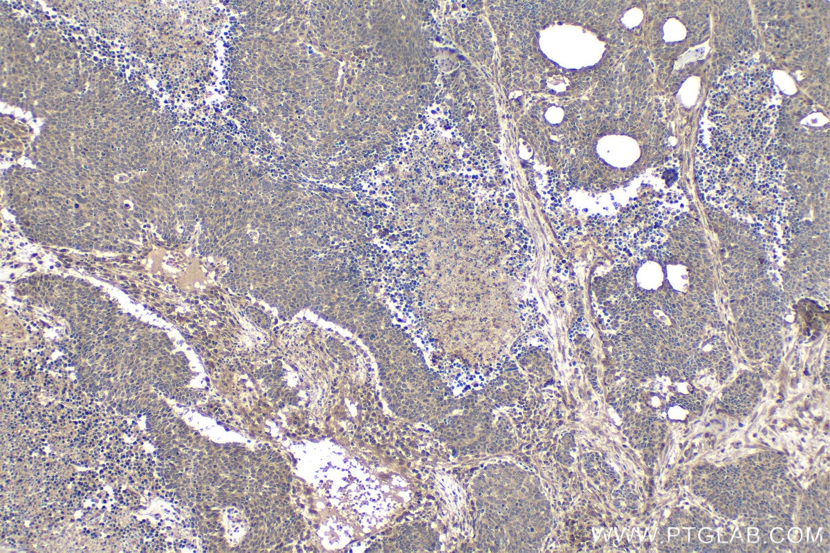 Immunohistochemical analysis of paraffin-embedded human lung cancer tissue slide using KHC1616 (CDK7 IHC Kit).