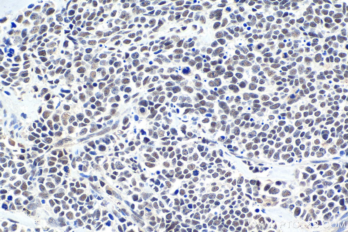 Immunohistochemical analysis of paraffin-embedded human lung cancer tissue slide using KHC1617 (CDK9 IHC Kit).