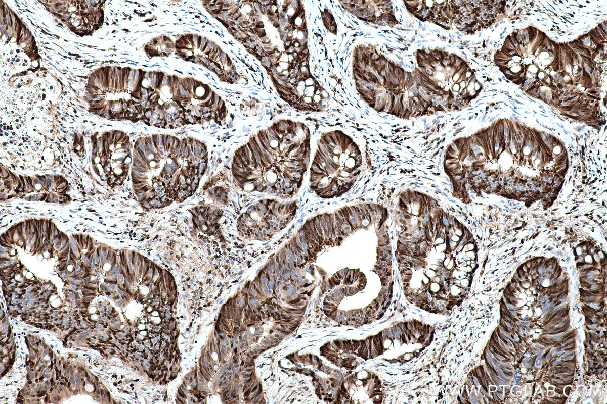 Immunohistochemical analysis of paraffin-embedded human colon cancer tissue slide using KHC0773 (CDKN1B IHC Kit).