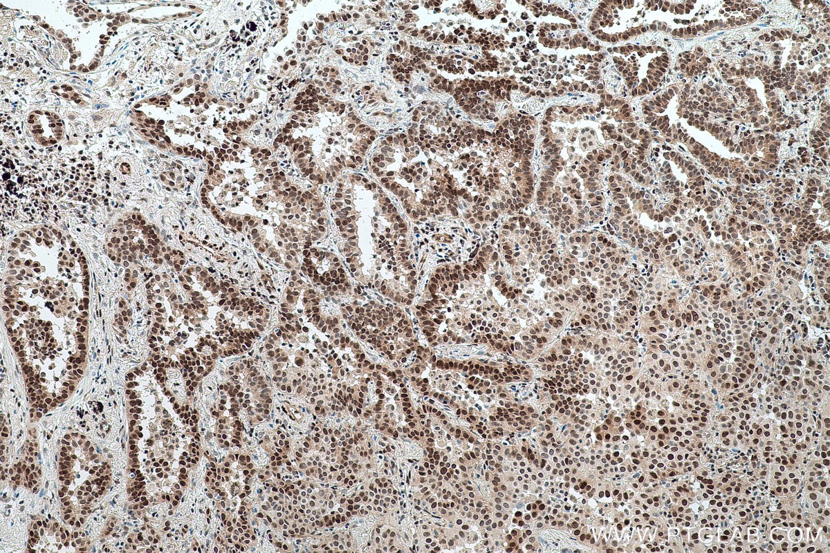Immunohistochemical analysis of paraffin-embedded human lung cancer tissue slide using KHC0773 (CDKN1B IHC Kit).