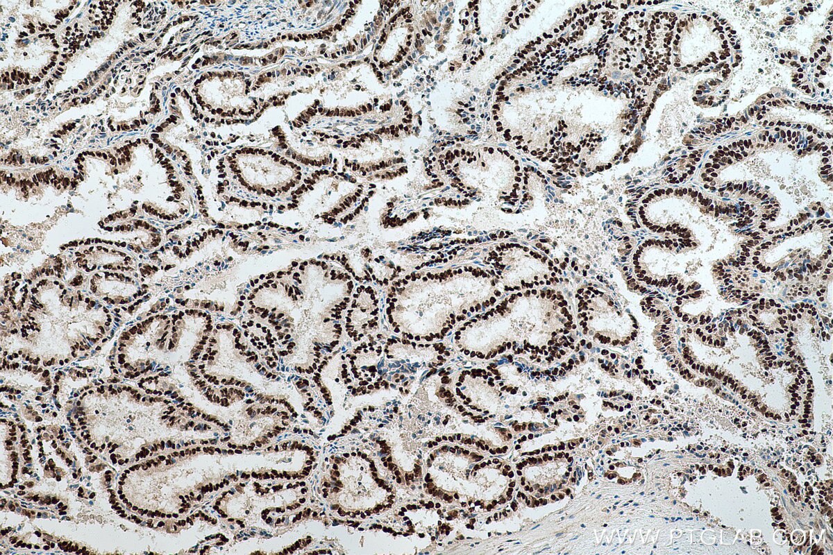 Immunohistochemical analysis of paraffin-embedded human ovary tumor tissue slide using KHC0773 (CDKN1B IHC Kit).