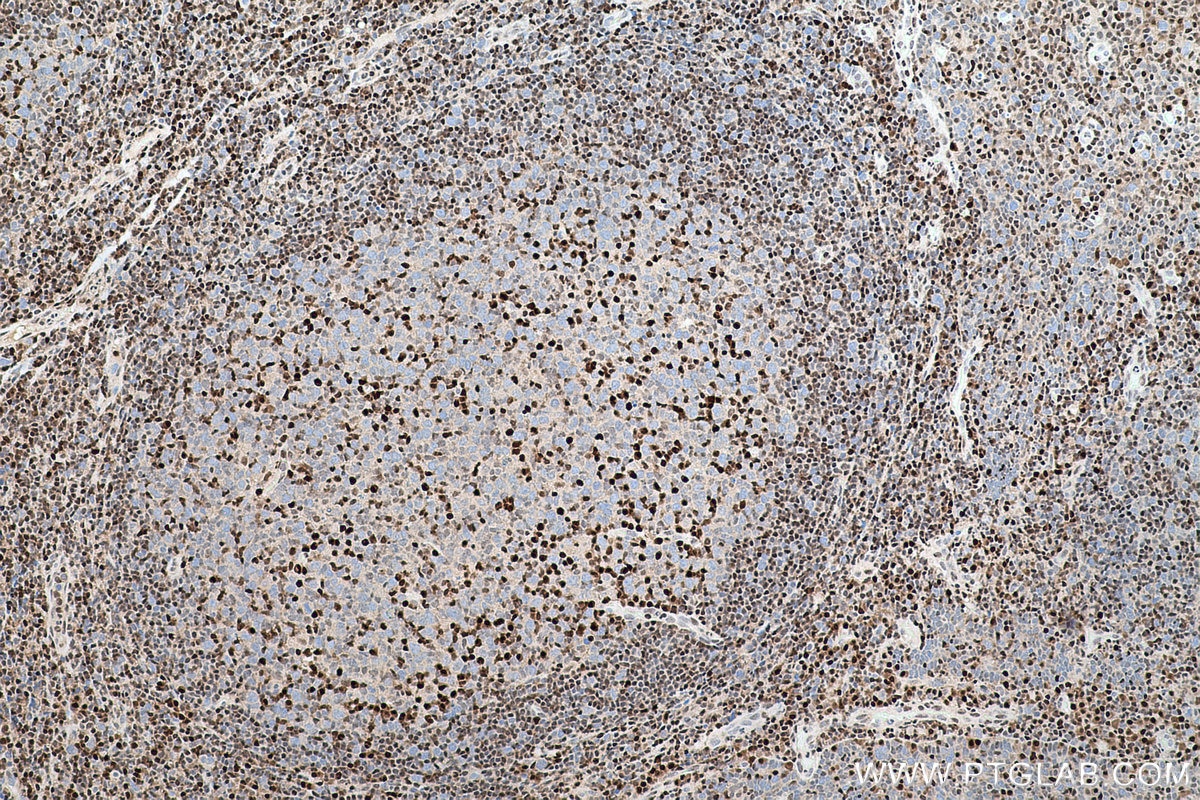 Immunohistochemical analysis of paraffin-embedded human tonsillitis tissue slide using KHC0773 (CDKN1B IHC Kit).