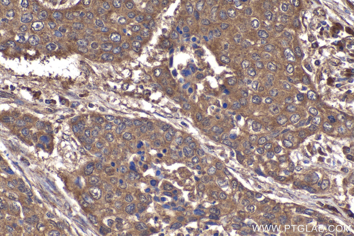Immunohistochemical analysis of paraffin-embedded human lung cancer tissue slide using KHC2037 (CDR2L IHC Kit).