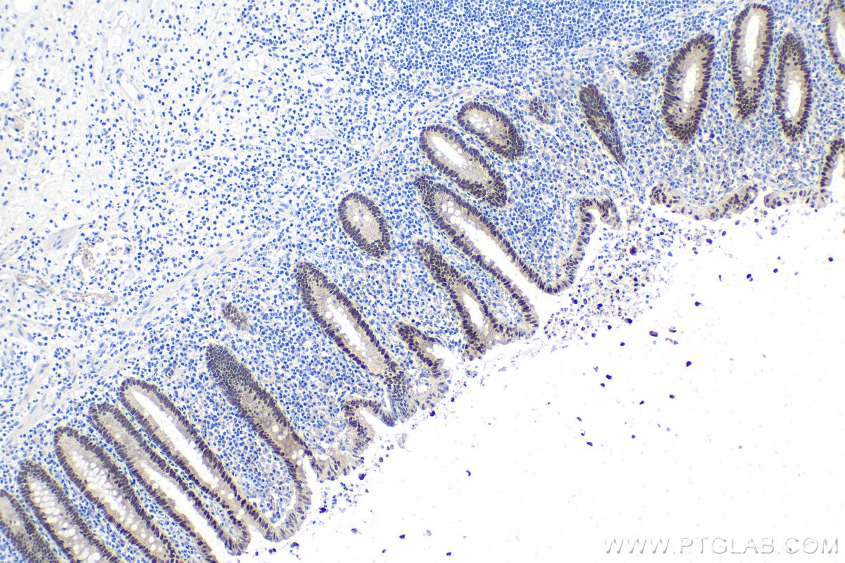 Immunohistochemical analysis of paraffin-embedded human appendicitis tissue slide using KHC1609 (CDX1 IHC Kit).