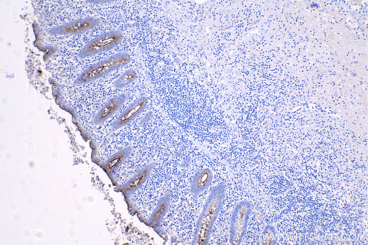 Immunohistochemical analysis of paraffin-embedded human appendicitis tissue slide using KHC1112 (CEA IHC Kit).