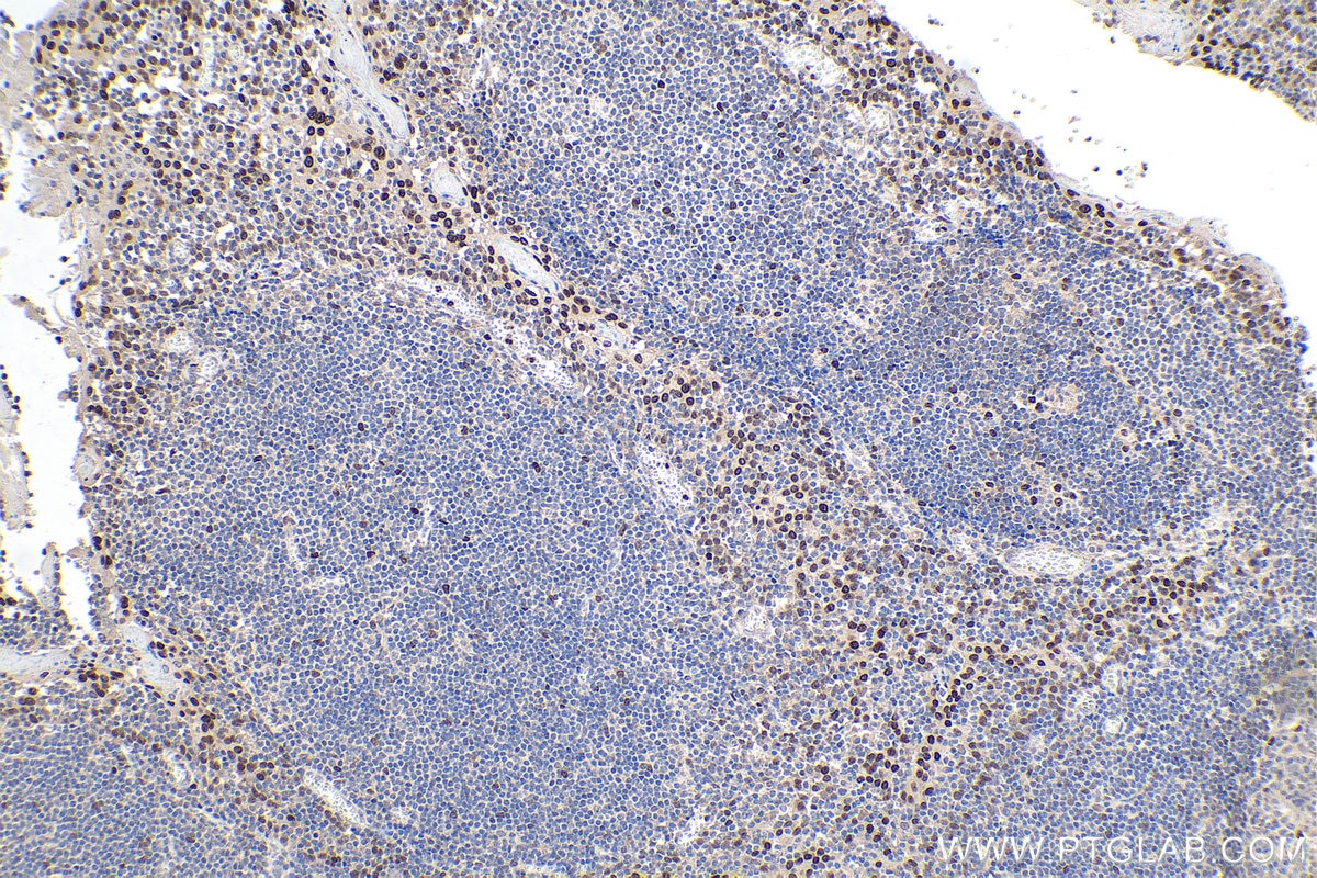 Immunohistochemical analysis of paraffin-embedded human tonsillitis tissue slide using KHC0239 (CEBPB IHC Kit).