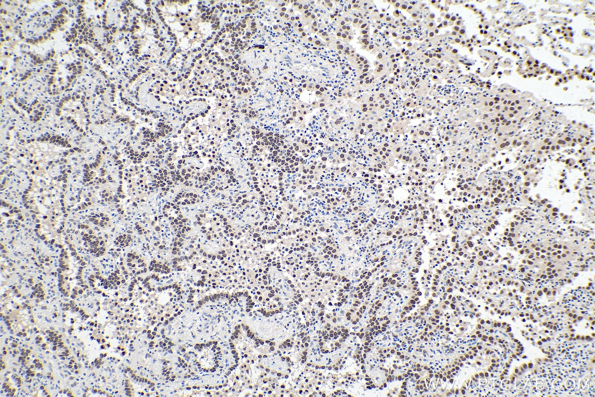 Immunohistochemical analysis of paraffin-embedded human lung cancer tissue slide using KHC0239 (CEBPB IHC Kit).