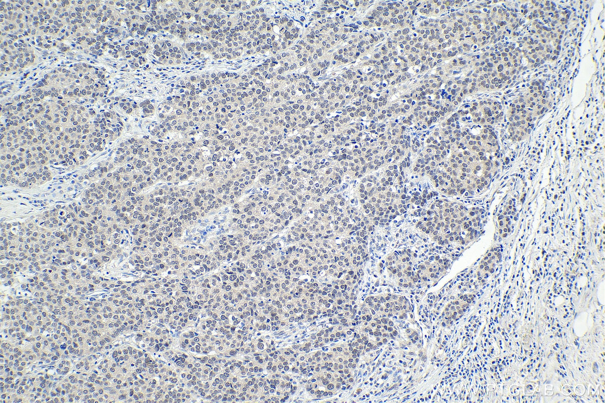 Immunohistochemical analysis of paraffin-embedded human stomach cancer tissue slide using KHC1625 (CEBPG IHC Kit).