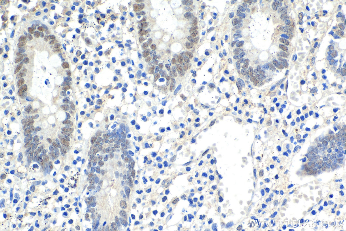 Immunohistochemical analysis of paraffin-embedded human appendicitis tissue slide using KHC1625 (CEBPG IHC Kit).