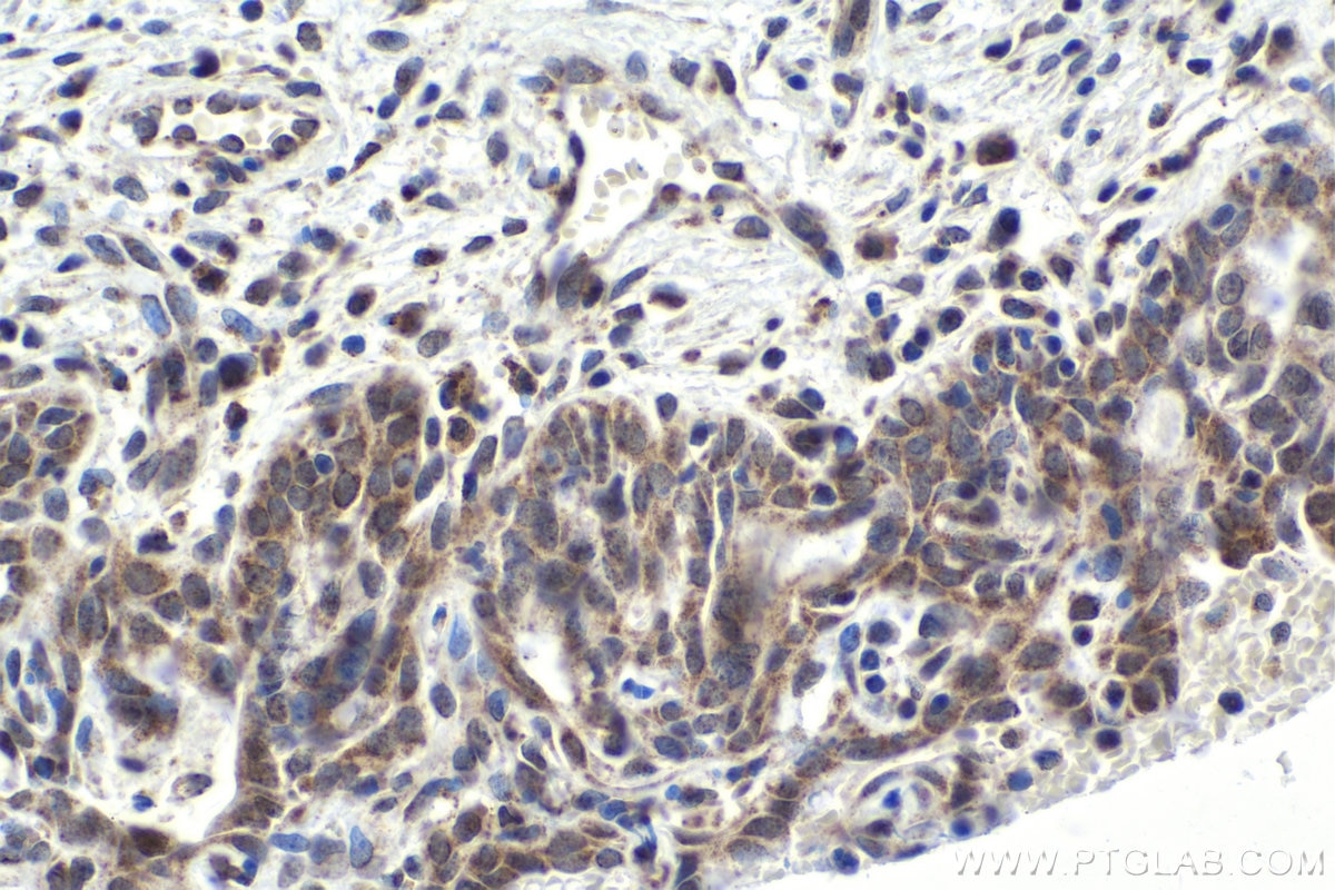 Immunohistochemical analysis of paraffin-embedded human cervical cancer tissue slide using KHC1778 (CELF3 IHC Kit).