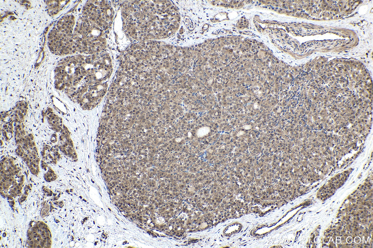 Immunohistochemical analysis of paraffin-embedded human thyroid cancer tissue slide using KHC1779 (CEP162 IHC Kit).