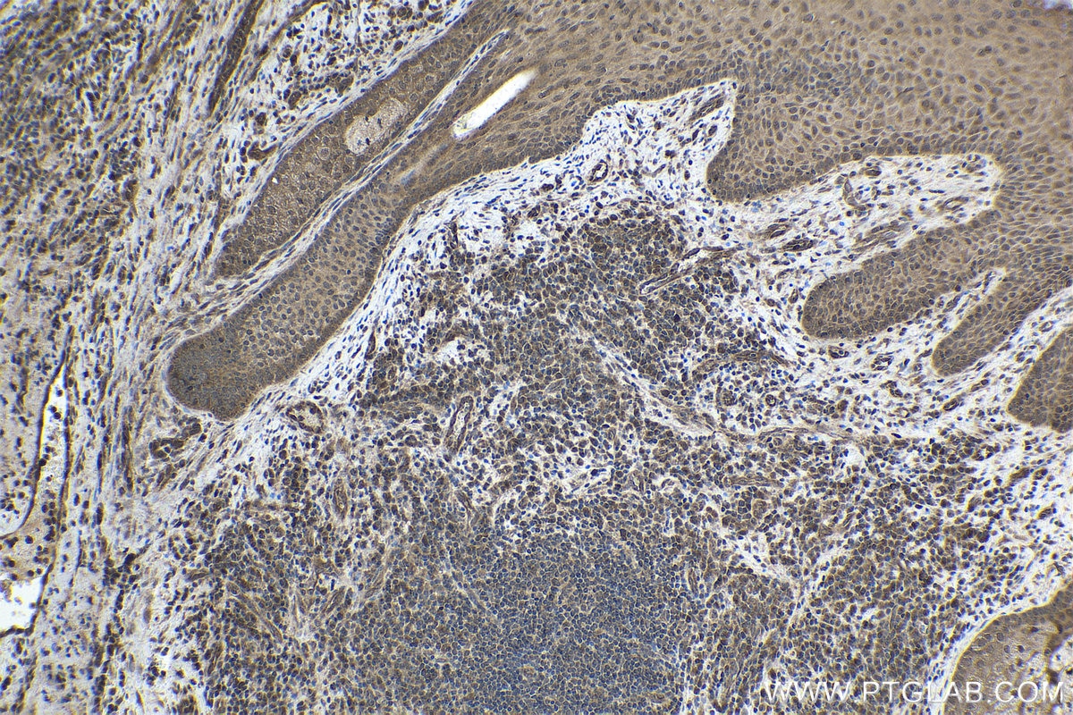 Immunohistochemical analysis of paraffin-embedded human skin cancer tissue slide using KHC1779 (CEP162 IHC Kit).