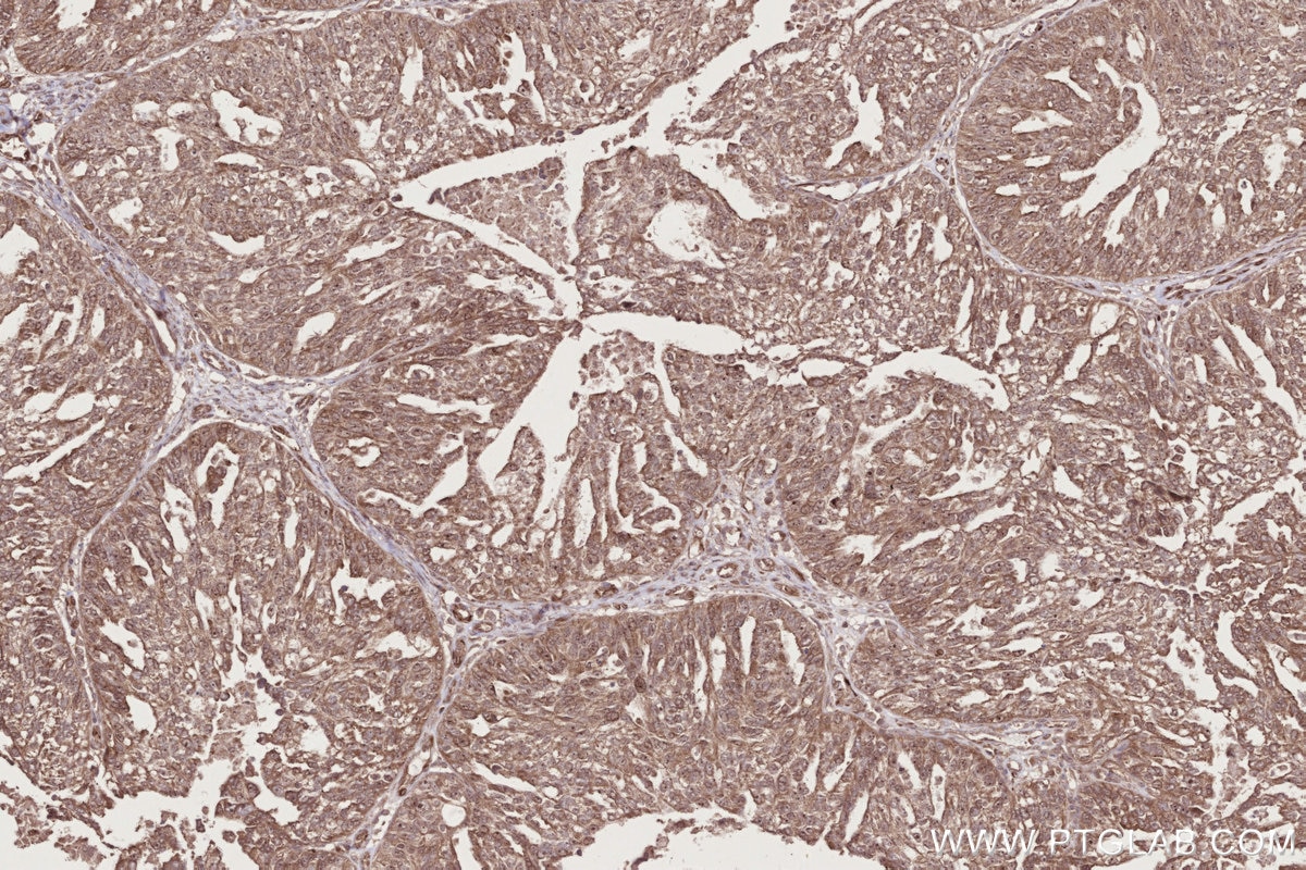 Immunohistochemical analysis of paraffin-embedded human ovary cancer tissue slide using KHC2724 (CEP192 IHC Kit).